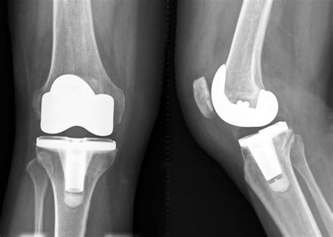 TOTAL KNEE ARTHROPLASTY (TKA) Total Knee .